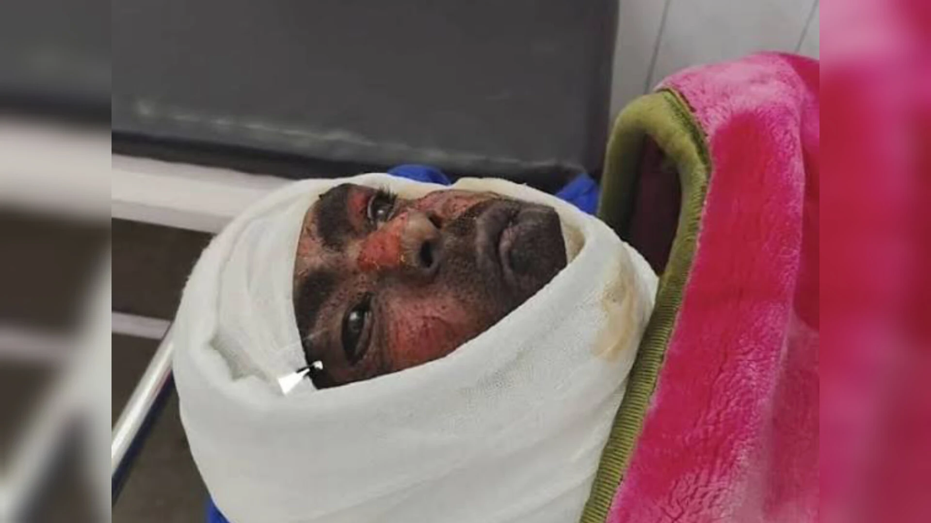 बुढ़ाना में युवक ने खुद पर पेट्रोल डालकर लगाई आग, दिल्ली रेफर