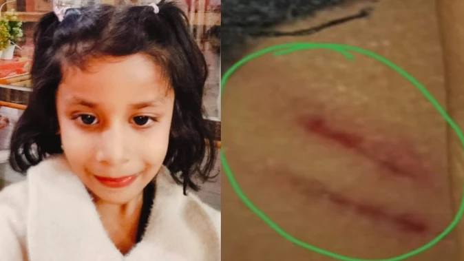 मेरठ: पल्लवपुरम में आवारा कुत्तों का आतंक, 5 साल की बच्ची पर हमला