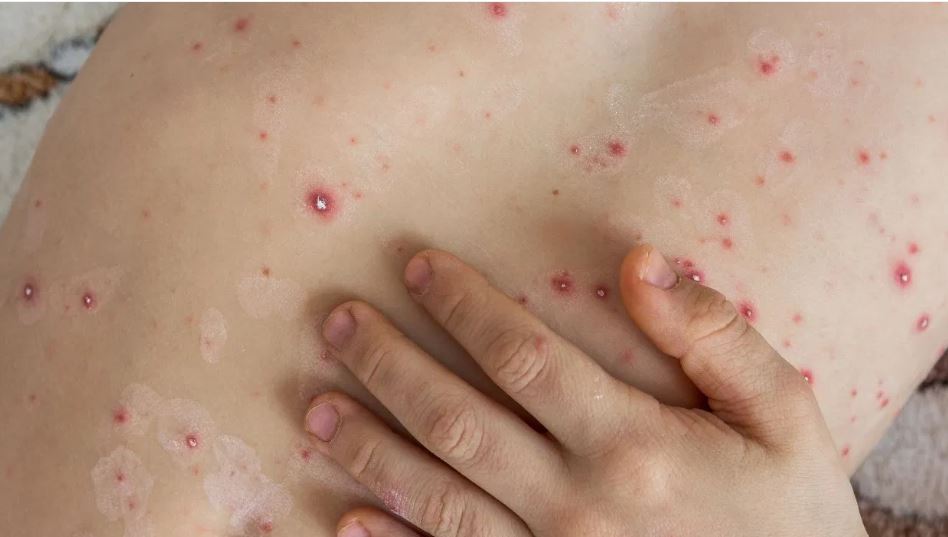 केरल में तेजी से फैल रहा है चिकनपॉक्स, 6 हजार से ज्यादा मामले