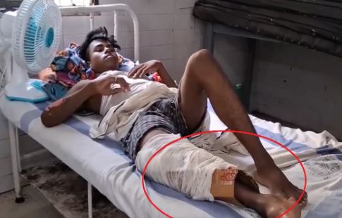 अजब बिहार में गजब की लापरवाही! पैर में प्लास्टर की जगह बांध दिया कार्टन