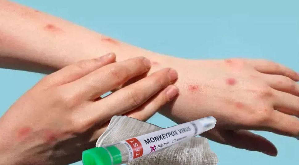 देश में मिला मंकीपॉक्स का दूसरा केस, क्या खतरनाक बन रहा है ये वायरस?