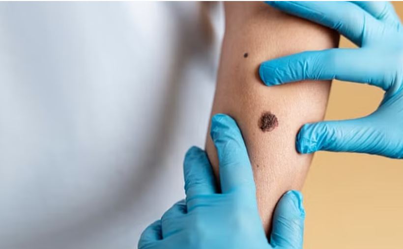 भारत में मंकीपॉक्स का खौफ, एक संदिग्ध को किया गया आइसोलेट