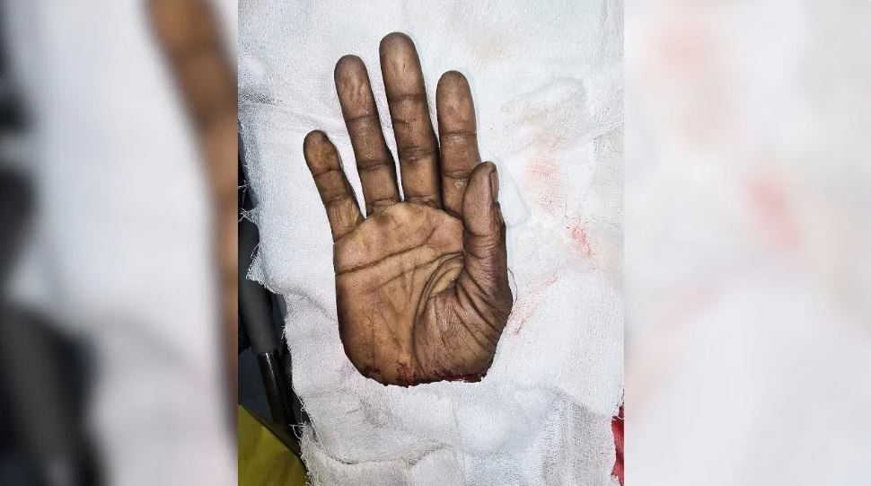 चमत्कार से कम नहीं! फैक्ट्री में कटी मजदूर की हथेली, 9 घंटे चला ऑपरेशन