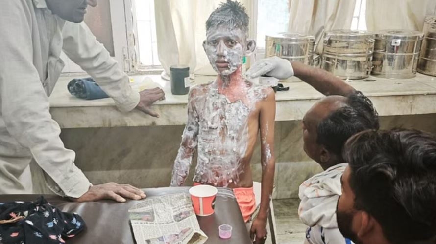 पटाखों पर पेट्रोल डालकर स्टंट कर रहा था किशोर, चिंगारी से बुरी तरह झुलसा