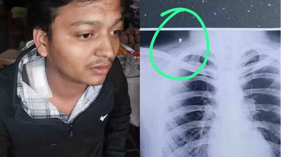 चित्तौड़गढ़: अनाज व्यवसायी फायरिंग केस, पसली से आठ दिन बाद निकला धातु का टुकड़ा