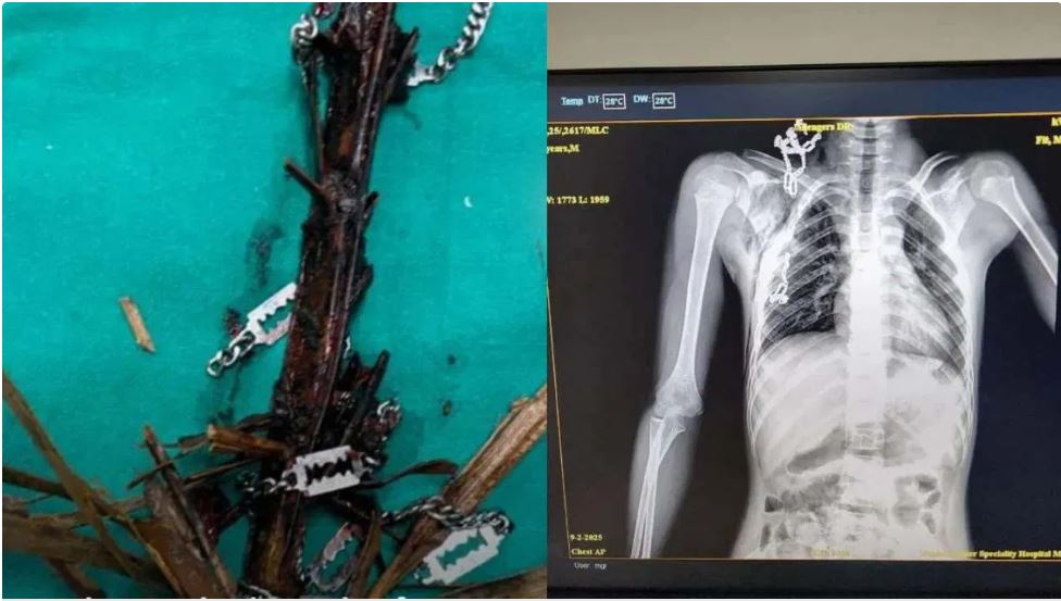 लड़के के गले से निकली ब्लेड वाली चेन, लकड़ी का टुकड़ा… देखकर डॉक्टर भी हैरान